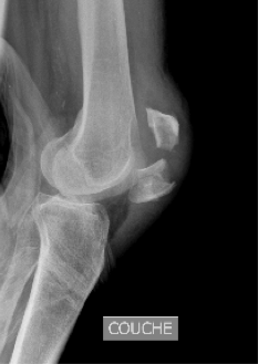 Fracture de la rotule – Orthopole du Renaison